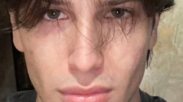 From Bone Smashing To Chin Extensions, Here Are Before-And-After Collages Of "Looksmaxxing" Influencers