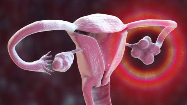 PCOS Is Officially Renamed, After Decades of Misinformation