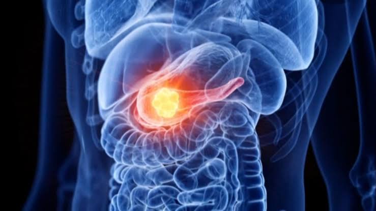 High hopes for new pancreatic cancer therapies