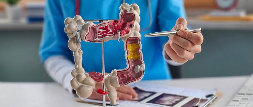 FAQs on Colorectal Cancer, Treatment, and Prevention