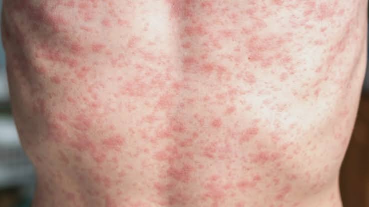 Oregon Health Authority identifies two measles exposure sites in Keizer