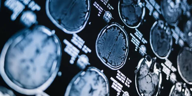 Anti-amyloid Alzheimer’s drugs show no clinically meaningful effect