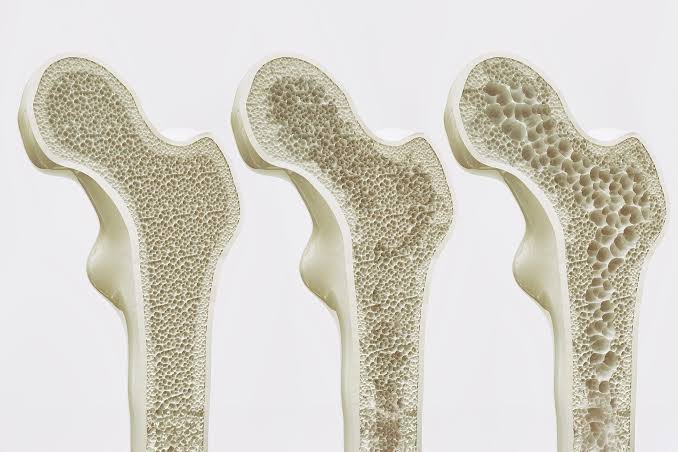 Bone-Strengthening Discovery Could Reverse Osteoporosis