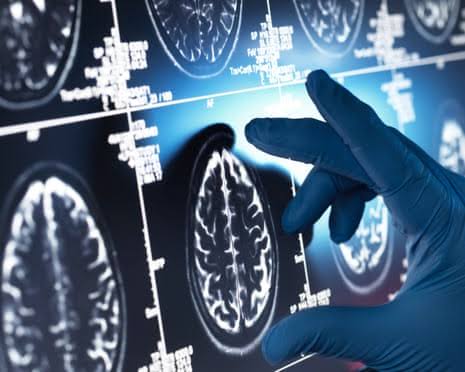 Effect of ‘gamechanger’ Alzheimer’s drugs ‘trivial’, review concludes | Dementia