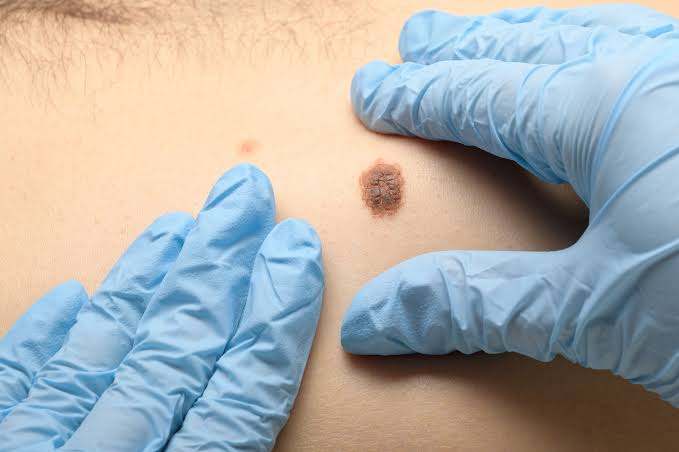Love the skin you’re in? Check it for signs of cancer