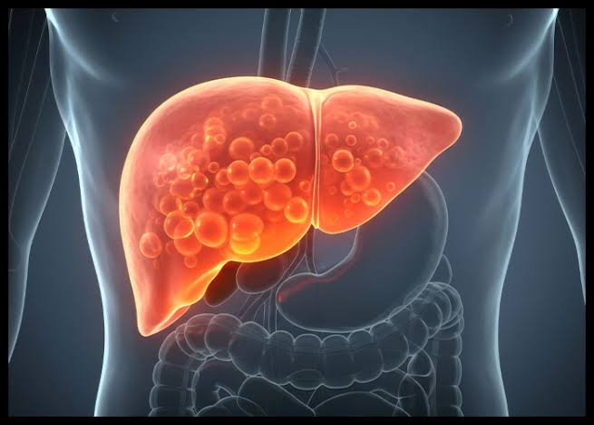 Existing Drugs Show Promise In Treating Fatty Liver Disease, Study Says