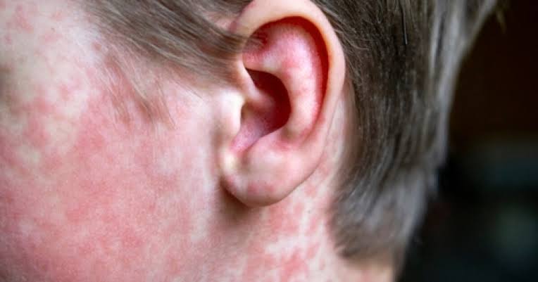 Maricopa County public health officials confirm measles exposure in Queen Creek, list locations