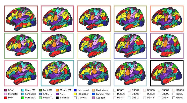 Imaging study sheds light on how deep brain stimulation acts on Parkinson's disease