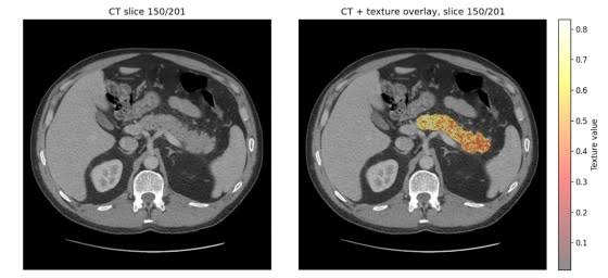 AI finds signs of pancreatic cancer before tumors develop