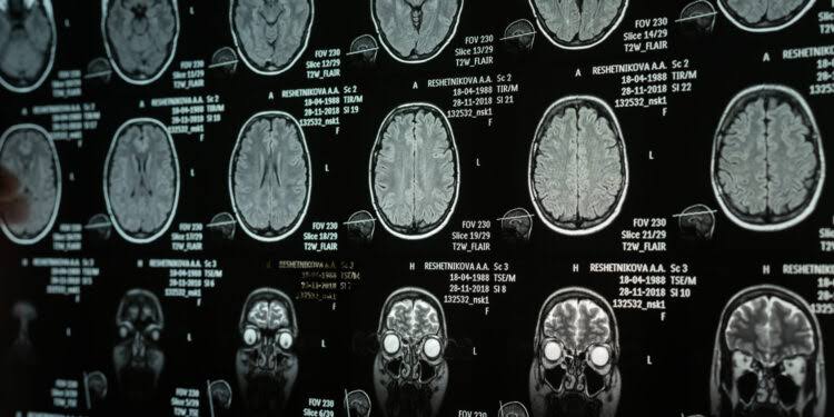 Narcissistic traits are linked to a brain area governing emotional control