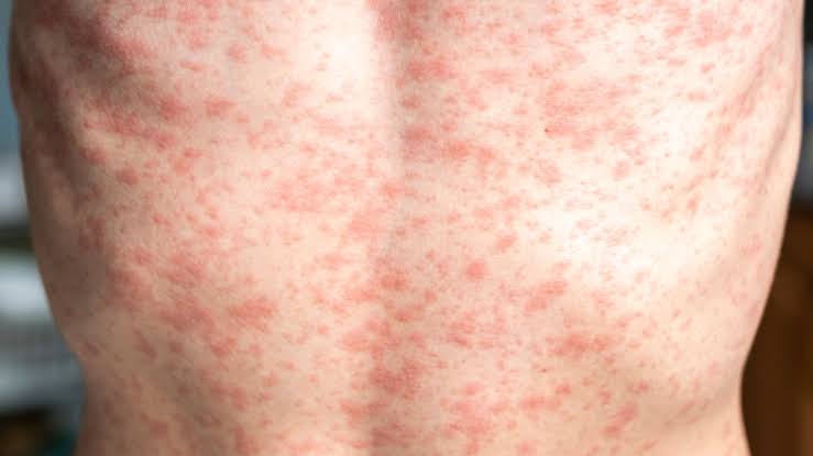 Measles cases confirmed in Manhattan and Long Island: What to know