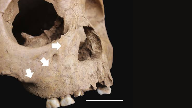 Ancient children's teeth reveal a syphilis-like disease was spreading in Vietnam 4,000 years ago