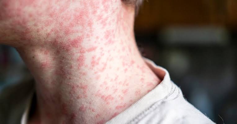 Confirmed case of measles in Manhattan, NYC DOH says