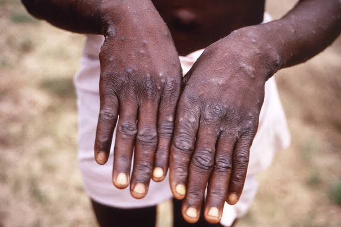San Francisco reports first case of more severe mpox strain