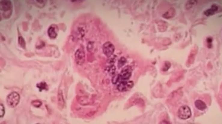 Multnomah County measles case highlights need for ‘protecting yourself,’ officials say