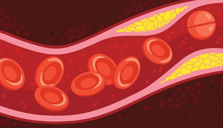 Understanding Statins and the New Cholesterol Guidelines