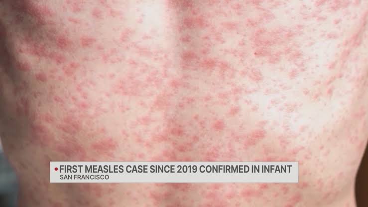 First measles case since 2019 confirmed in SF infant