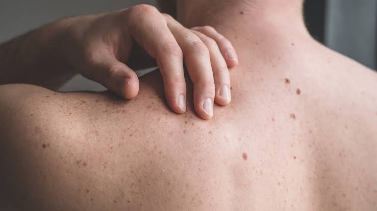 How to spot and prevent the deadliest form of skin cancer