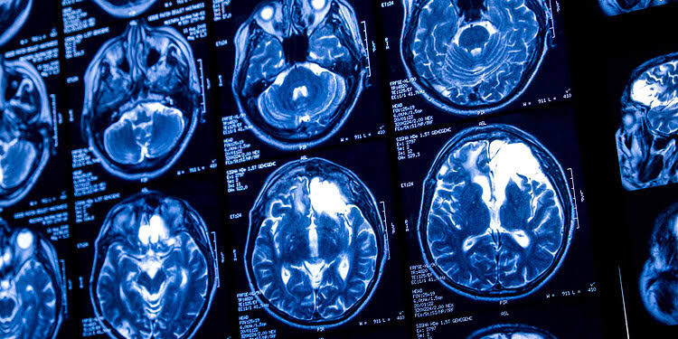 Even light drinking combined with aging is linked to reduced brain blood flow and thinner tissue