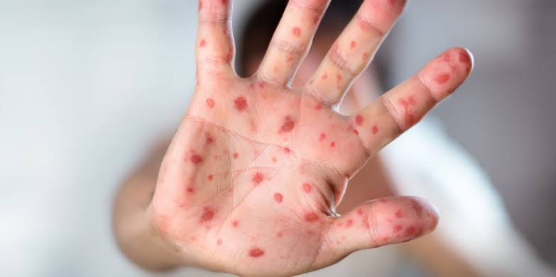 Salem medical office, waiting room identified as measles exposure sites