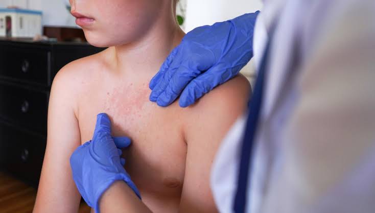 South Carolina measles outbreak ends as US cases near 1,800