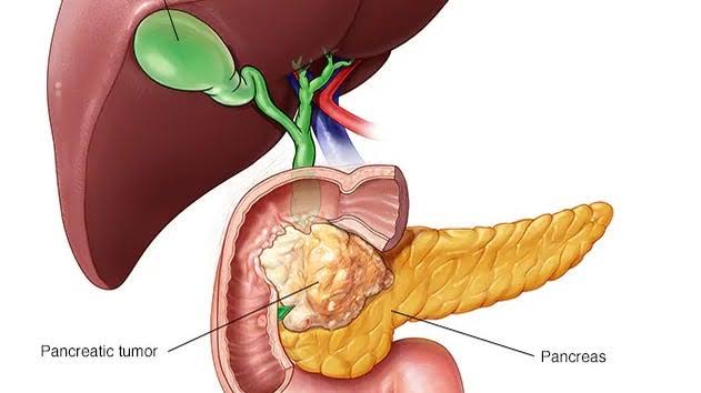 FDA green lights early access to pancreatic cancer drug, daraxonrasib