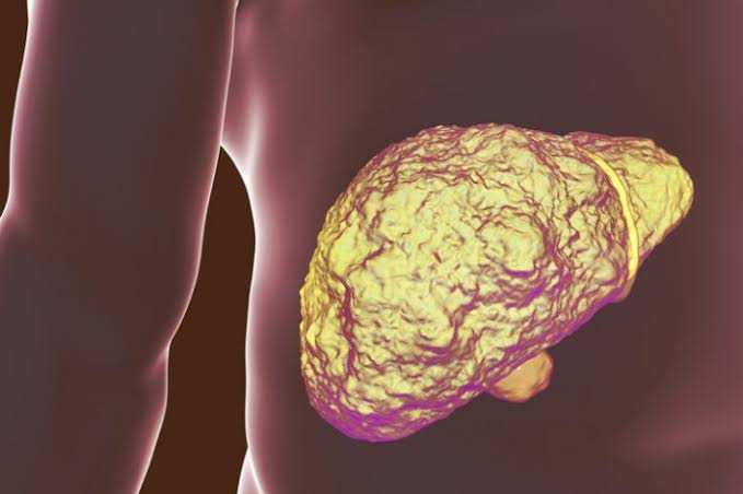 Occasional Heavy Drinking Triples Odds of Liver Fibrosis in At-Risk Individuals