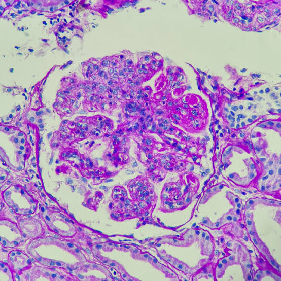 5 years after lupus breakthrough, CAR-T is still surprising autoimmunity researchers