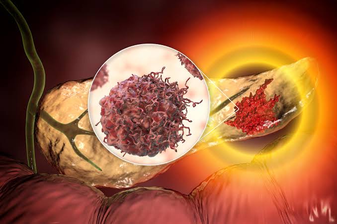 AI Detects “Invisible” Signs of Pancreatic Cancer Years Before Diagnosis