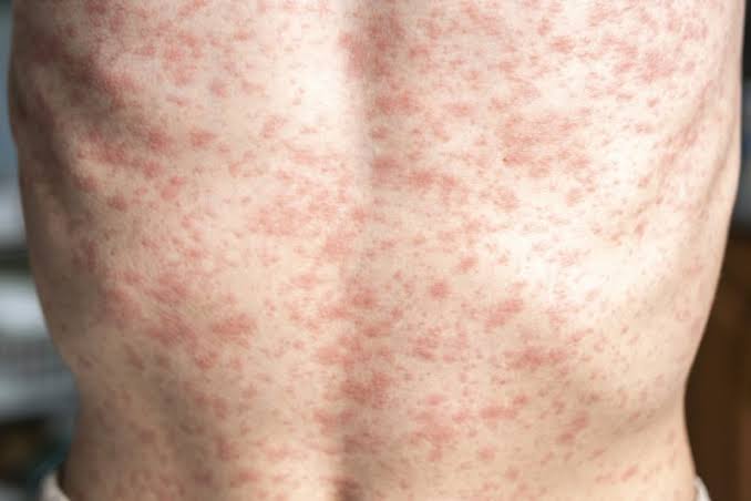 5 measles cases found in NYC in 2026: What to know