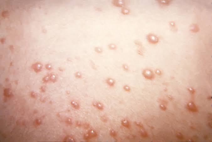 In rare chickenpox case, itchy blisters mushroom into large, rubbery nodules