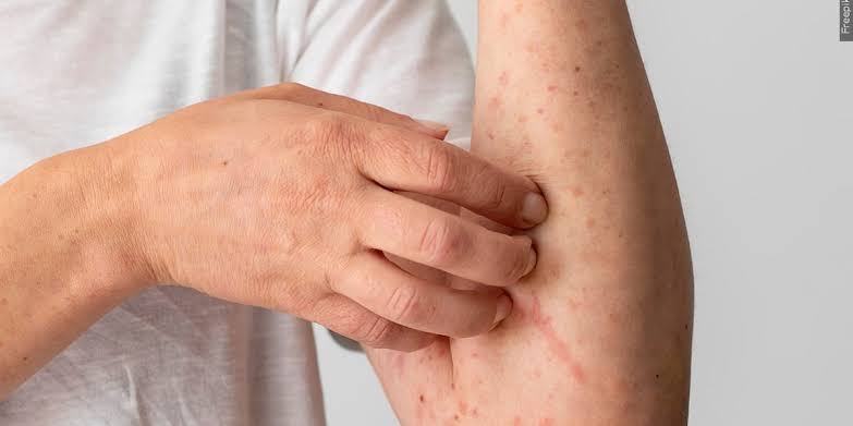 Fact Finders: What’s really happening with the measles case rate?