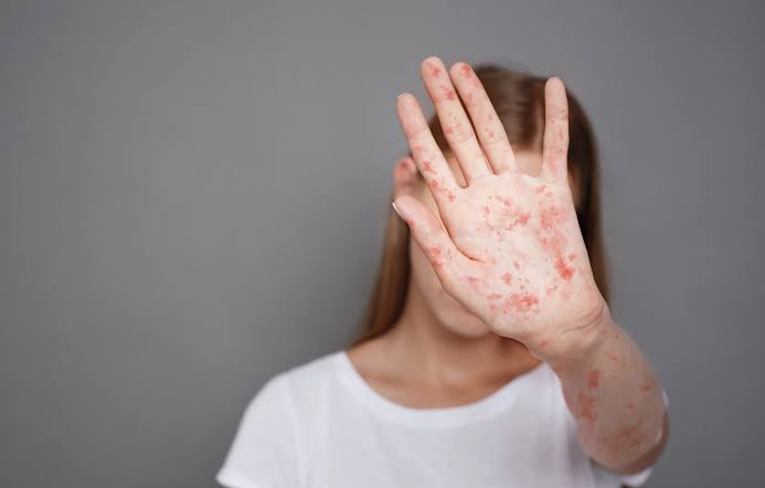 WDH reports first confirmed case of measles in Wyoming for 2026; Riverton store listed as possible exposure location