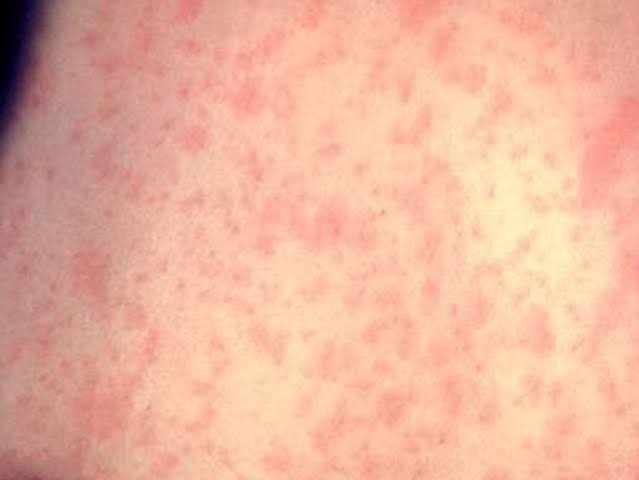 Measles could explode in Oregon in under-vaccinated areas, health officials warn