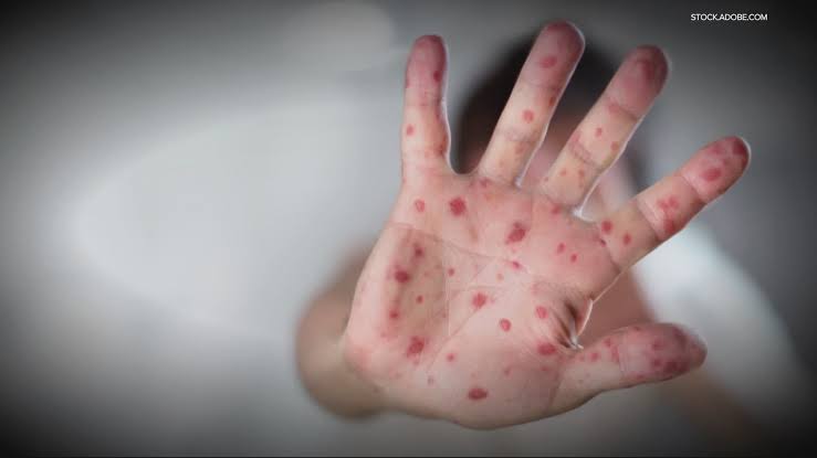 As measles cases climb, Oregon sees first hospitalization of the year