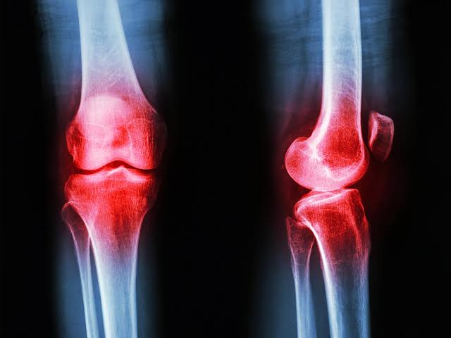 Unexpected Hormone Discovery Could Change How We Treat Arthritis