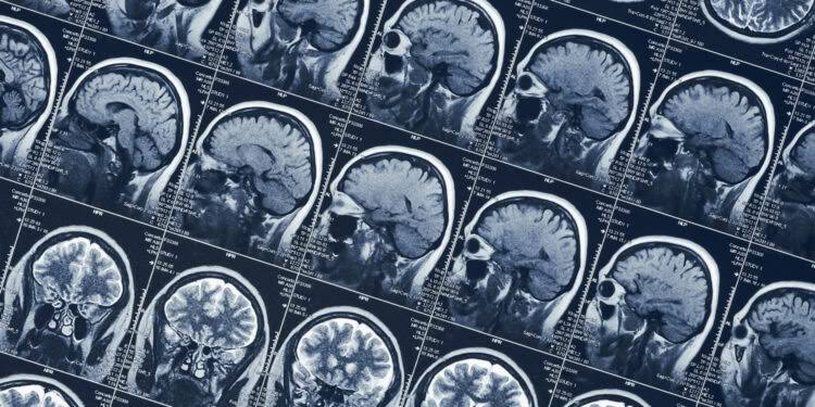 Brain scans reveal how a woman voluntarily enters a psychedelic-like trance without drugs