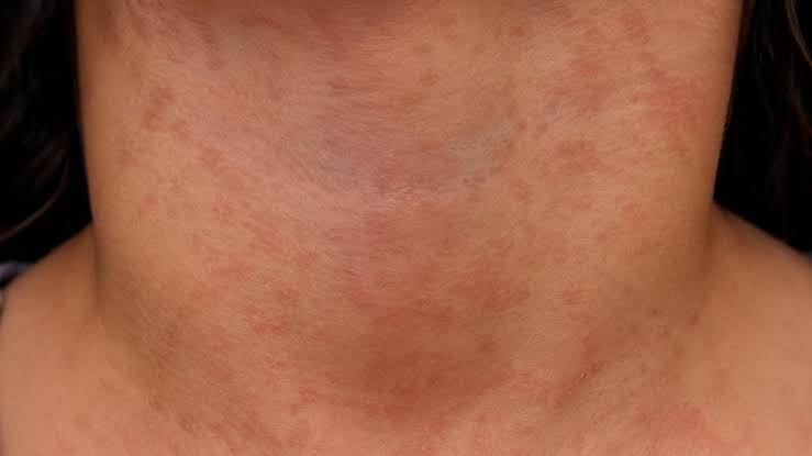 Oregon reports 1st measles hospitalization, likely community spread