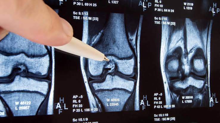 Common knee surgery found ineffective, may make things worse