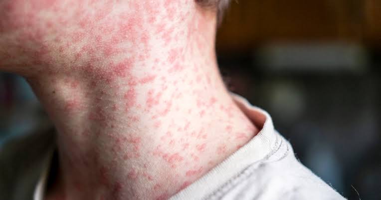 N.J. health officials warn of possible measles exposure at Newark Airport