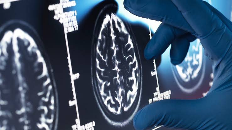 Much-Hyped Alzheimer's Drugs Show No Meaningful Benefit, Major Review Finds