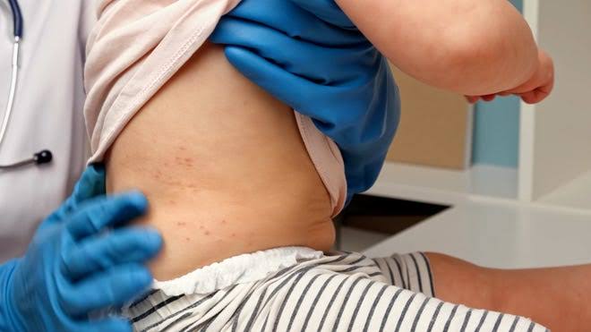 CDC warns additional measles cases expected during busy travel season