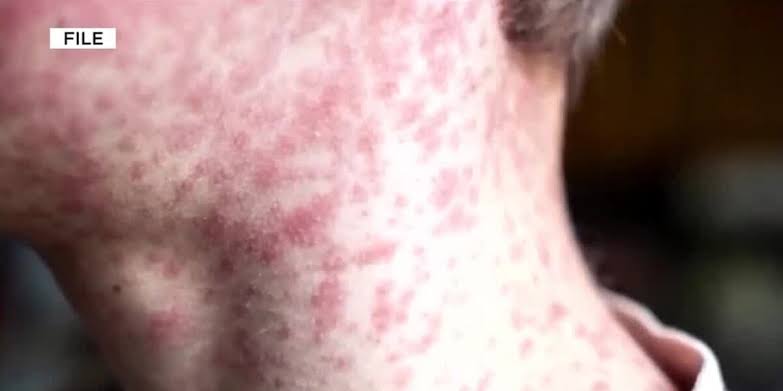 Health officials warn of measles exposure at Providence ER waiting room in NE Portland