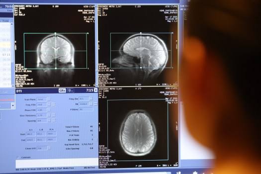 UCSD marijuana study affirms drug’s negative effect on youth