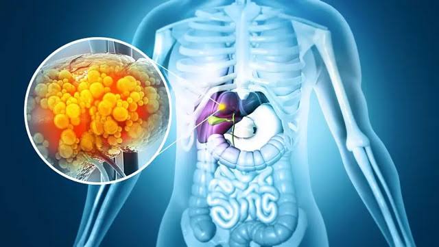 Existing drugs show promise in treating common fatty liver disease: study