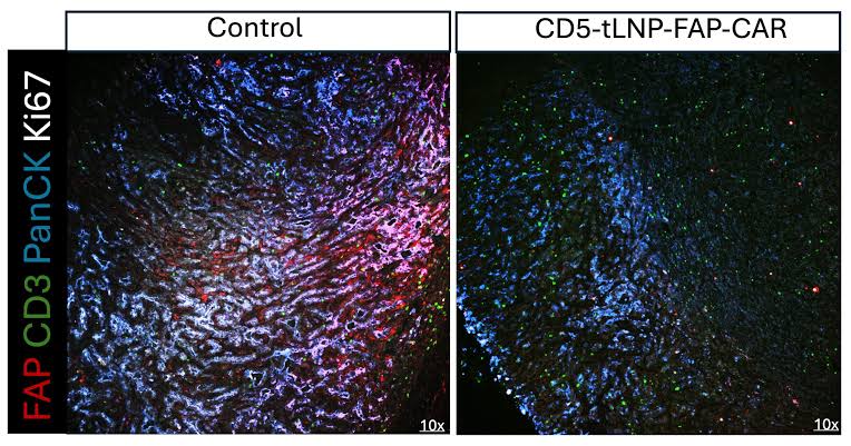 Targeting tumor supporting cells: Lipid nanoparticles advance CAR T success in pancreatic cancer