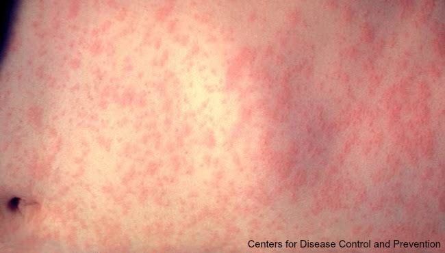 First measles case confirmed in Ottawa County since 1991