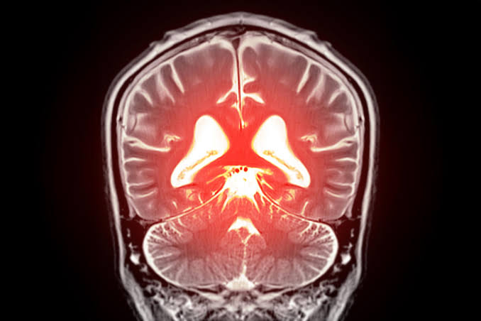AI Could Detect Early Signs of Alzheimer’s in Under a Minute – Far Before Traditional Tests