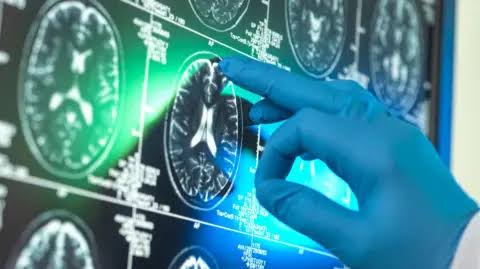 'Breakthrough' Alzheimer's drugs unlikely to benefit patients, report suggests