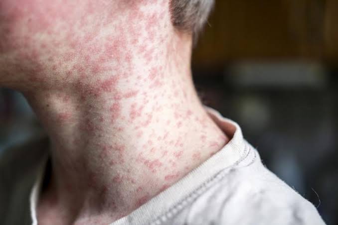 Utah now ‘epicenter’ of U.S. measles outbreak